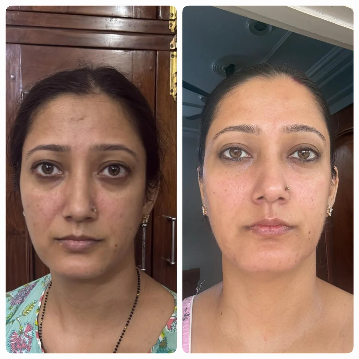 A student photographed front-on before and after Face Yoga practice