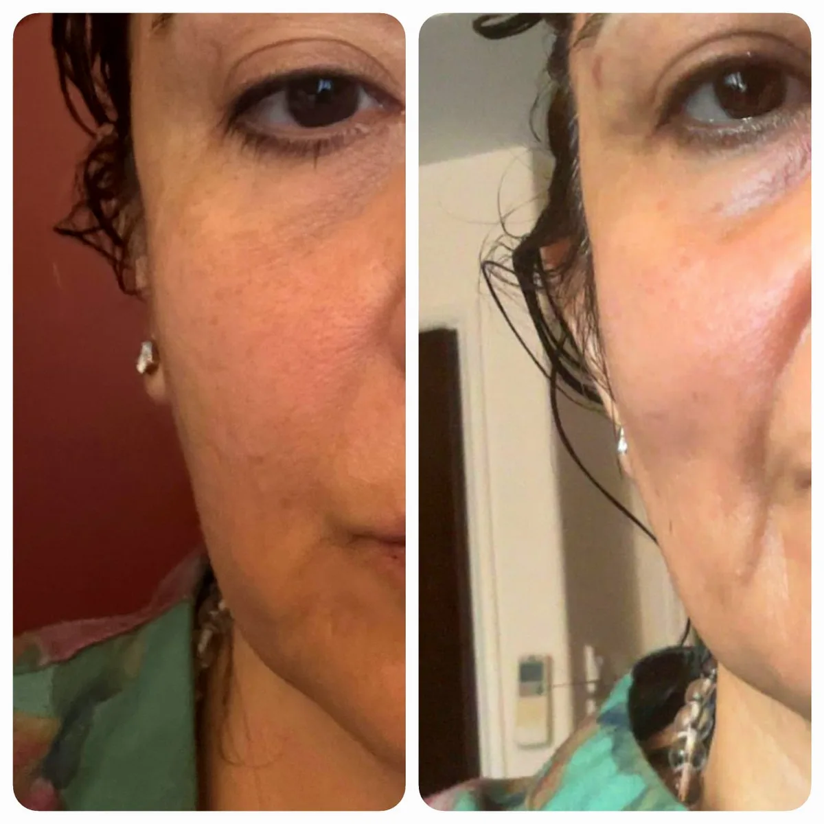 A student before and after — close-up of the cheek and jaw area